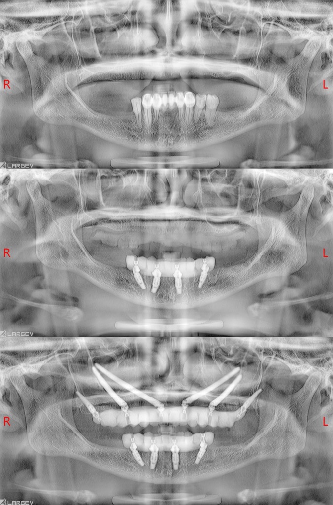 Three Levels of Full Arch Training
